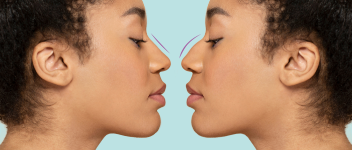 nose reshaping surgery in Hyderabad