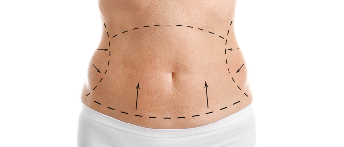 Full Body Liposuction in Hyderabad | Kinnera Aesthetica