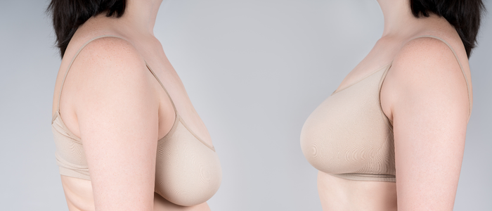 Breast reduction