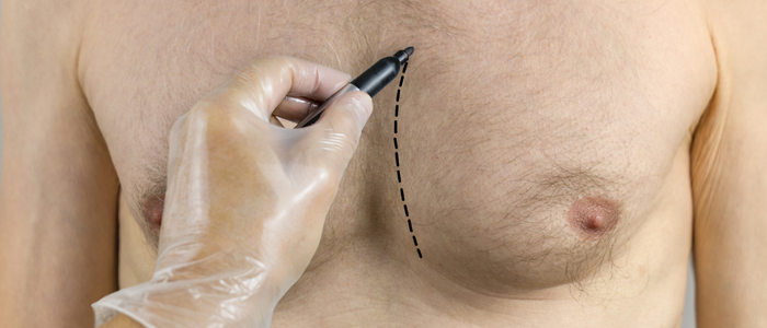 Gynecomastia correction