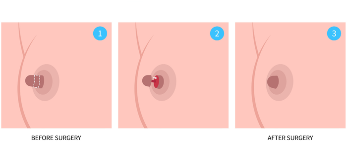 Nipple reduction surgery